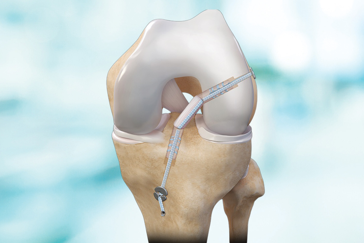 ACL Reconstruction