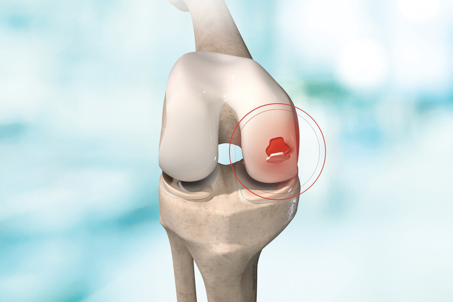 Cartilage Surgery