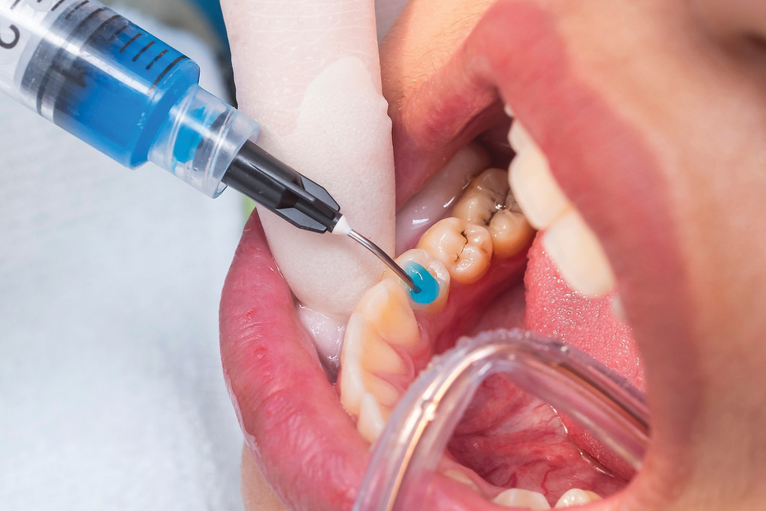 Fillings