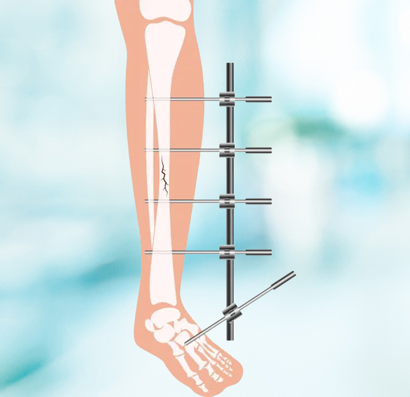 Fracture Fixation