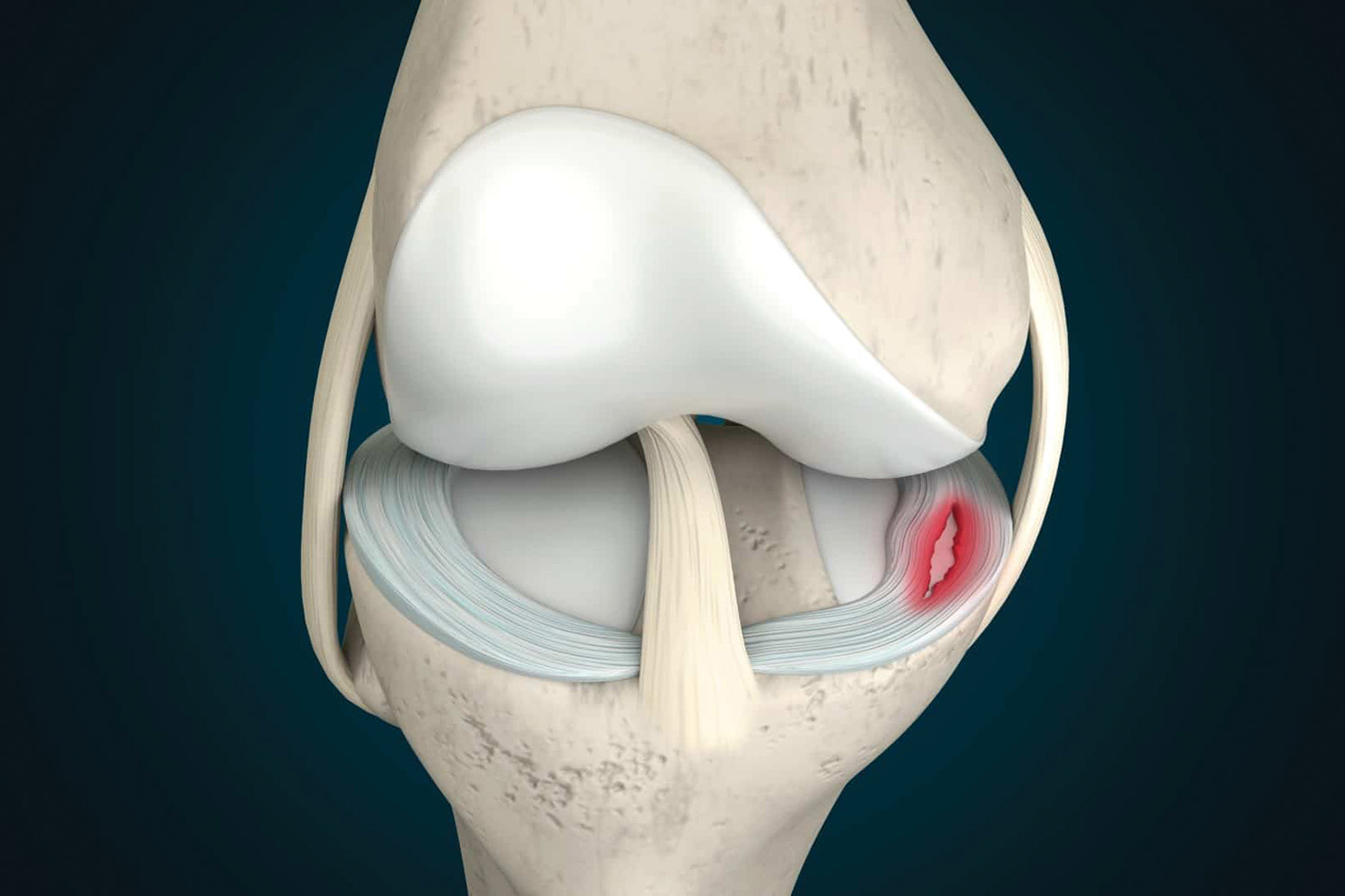 Meniscus Tear Management