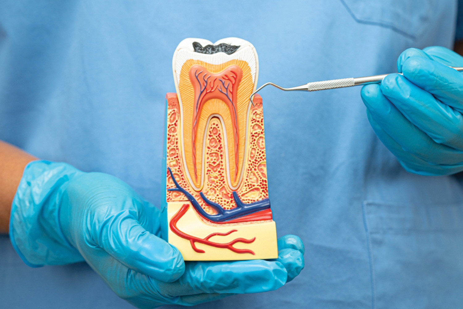 Root Canal Treatment