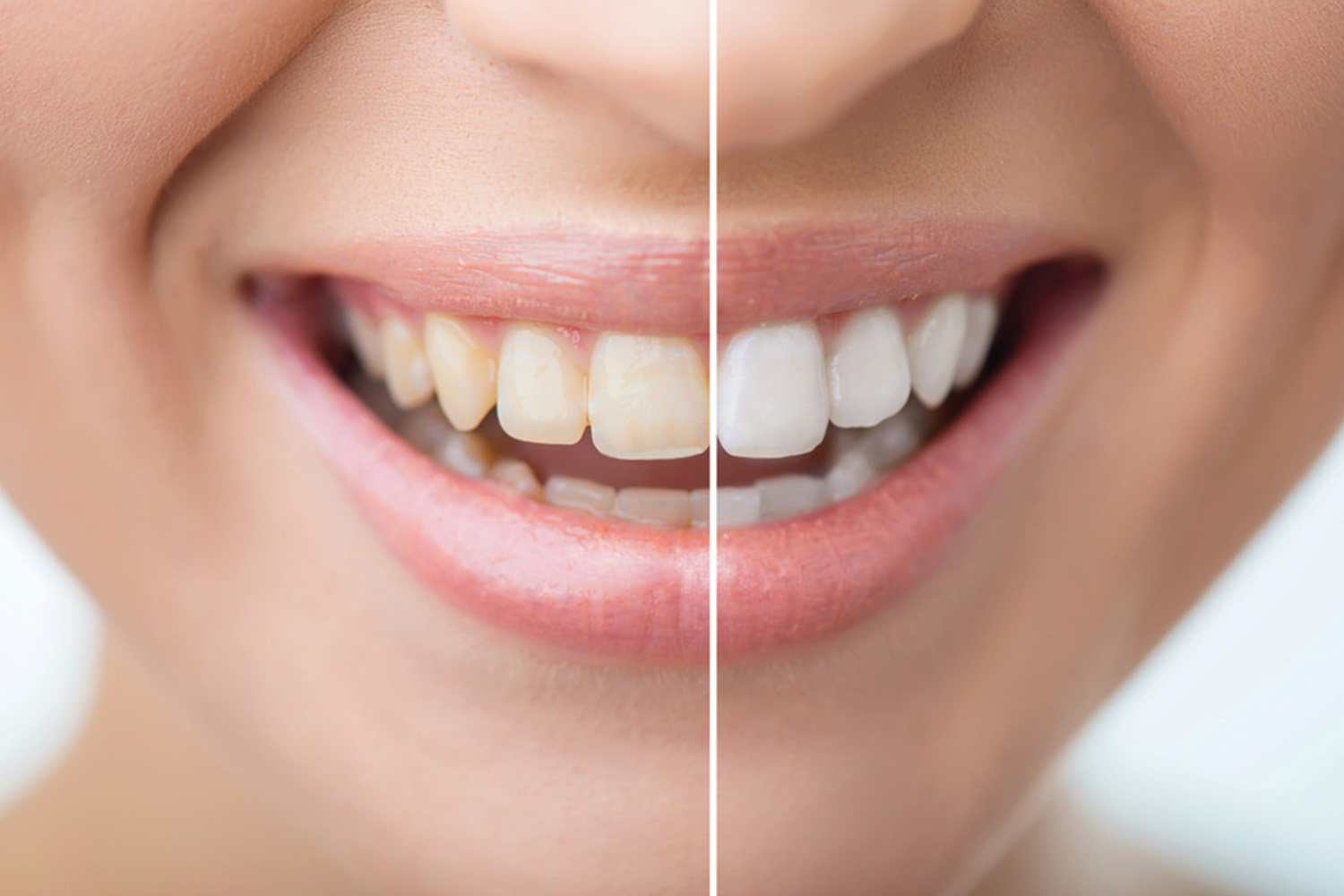Smile Correction