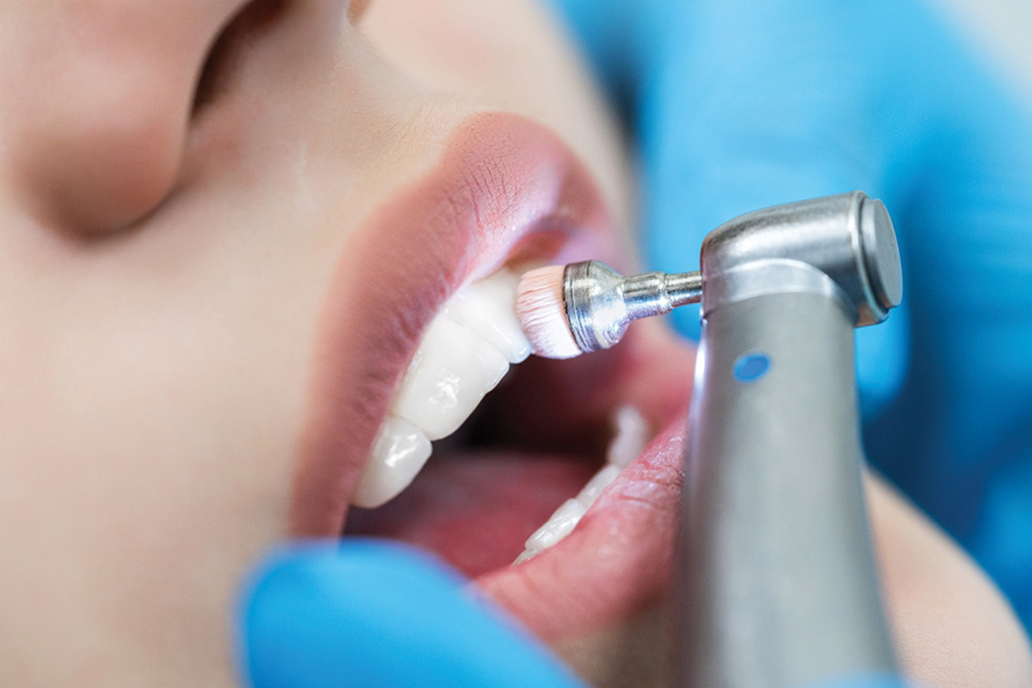Teeth Cleaning